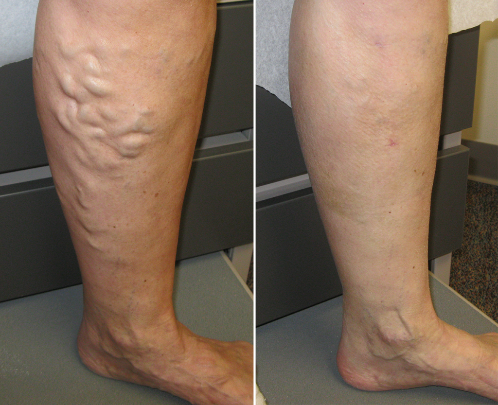What to Expect From Varicose Veins Treatment